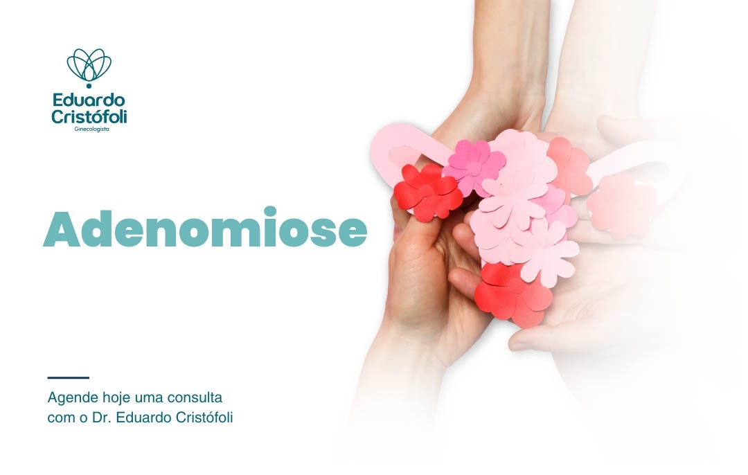 Agende hoje uma consulta com o Dr. Eduardo Cristófoli para tratamento de adenomiose e cuidados com a saúde feminina.