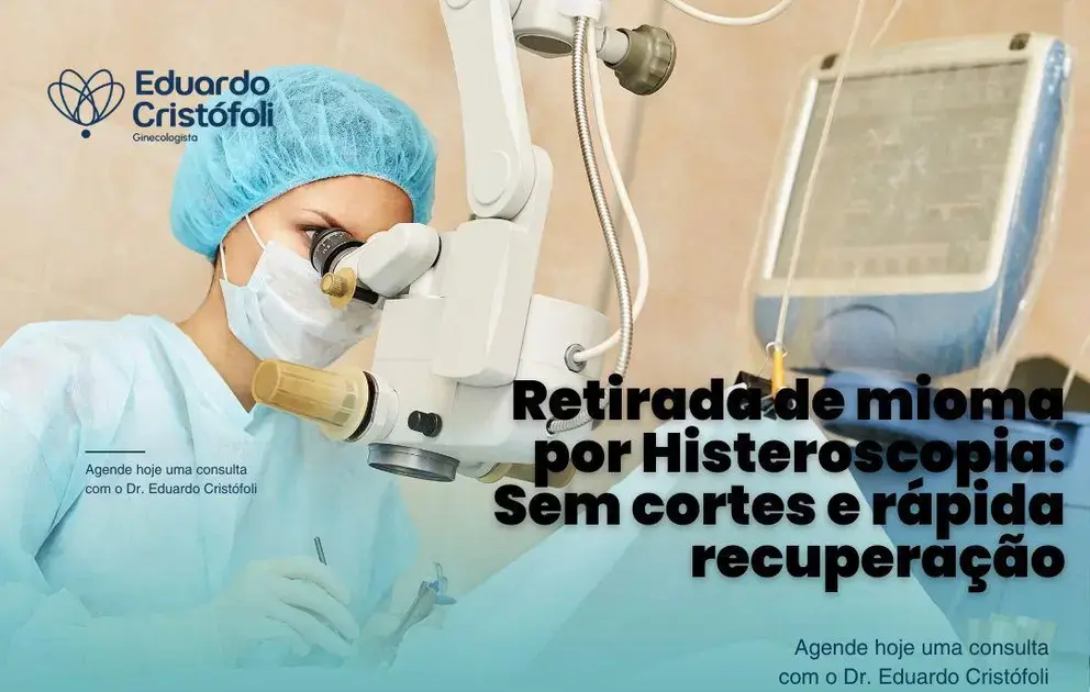 Retirada de mioma por Histeroscopia: Sem cortes e rápida recuperação