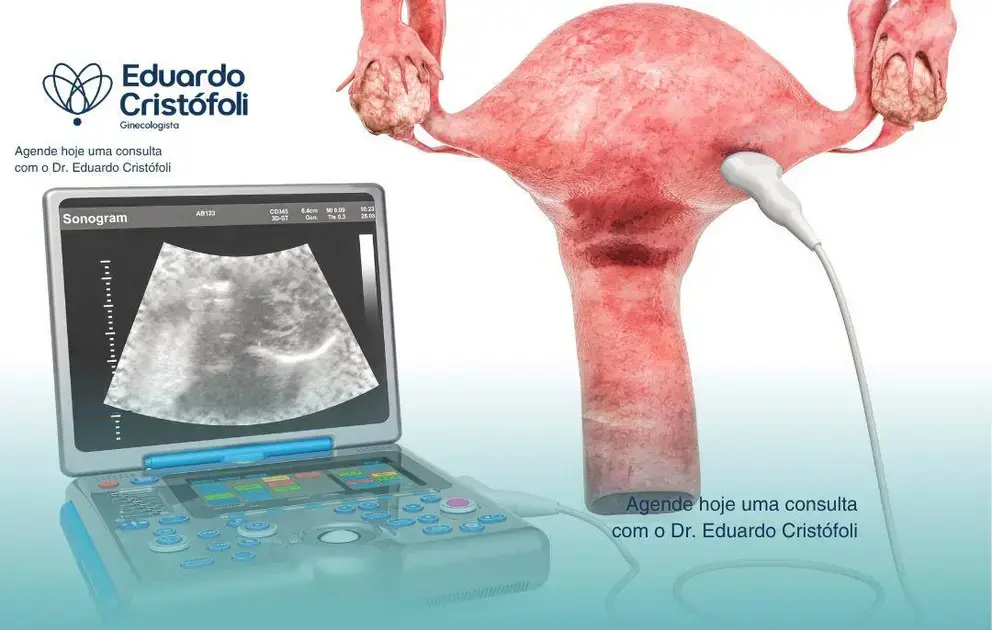 O papel do ultrassom ginecológico no acompanhamento e posicionamento do DIU.