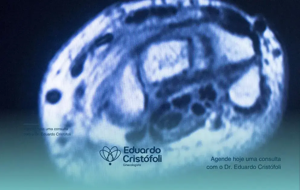 Tratamento para pólipos uterinos através da histeroscopia com alta precisão.