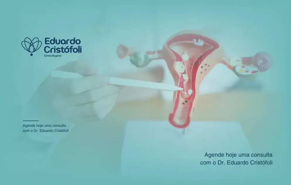 Remoção de pólipos uterinos: como funciona o procedimento seguro no consultório.