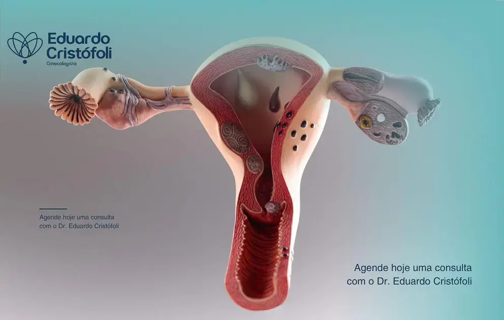 Histeroscopia ajuda investigar sangramento uterino completamente anormal.
