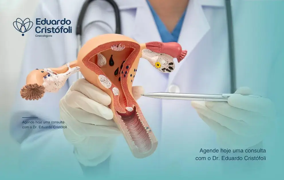 Histeroscopia cirúrgica trata pólipos uterinos com segurança.
