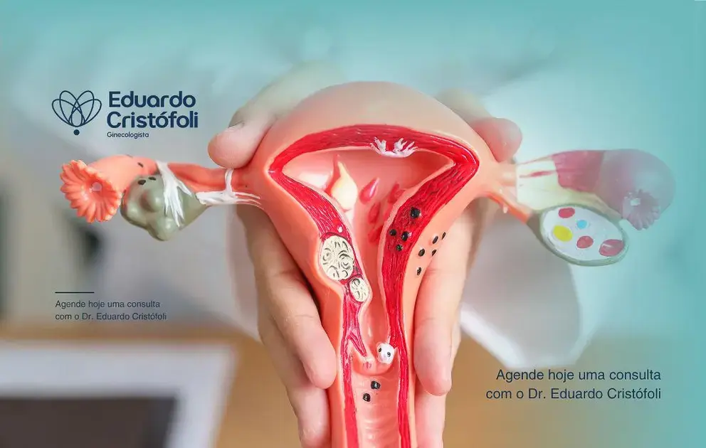 Colposcopia e a prevenção do câncer