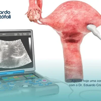 O papel do ultrassom ginecológico no acompanhamento e posicionamento do DIU.