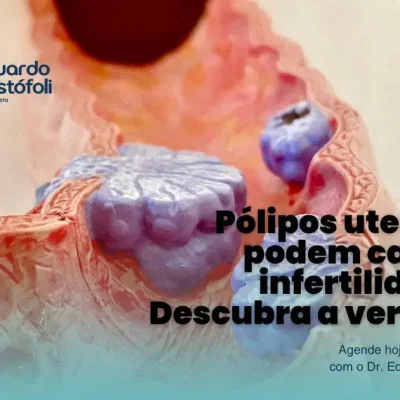 Pólipos uterinos podem causar infertilidade? Descubra a verdade