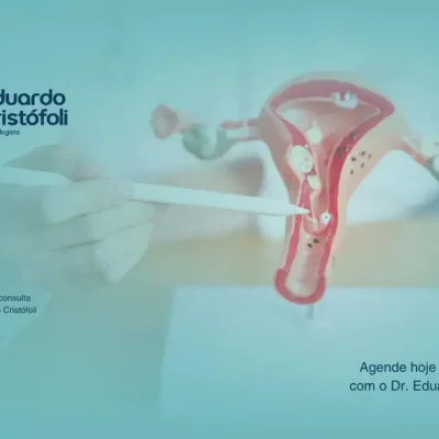 Remoção de pólipos uterinos: como funciona o procedimento seguro no consultório.