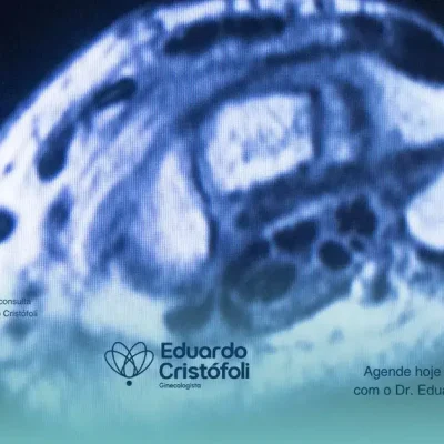 Tratamento para pólipos uterinos através da histeroscopia com alta precisão.